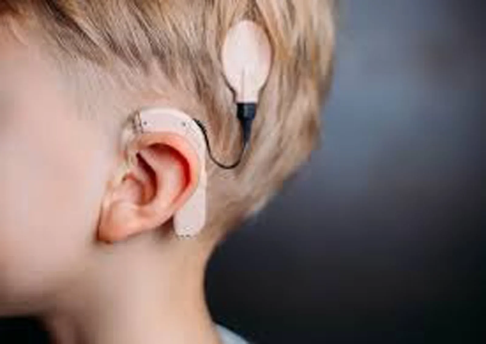 looking For Cochlear implant surgery in delhi? Consult dr Dhirendra at ORL Interntional Hospital